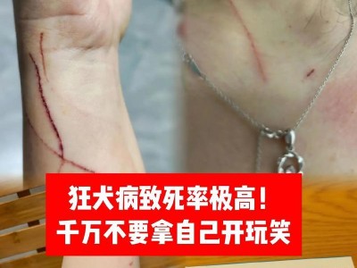 狂犬病（揭开狂犬病真相，守护人类安全）