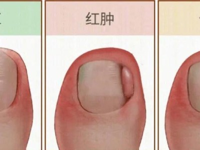 小狗甲沟炎的症状及处理方法（了解小狗甲沟炎的常见症状及有效治疗方法）