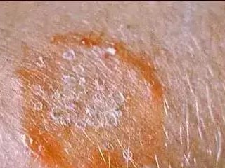探讨猫癣康复过程中的快速痊愈现象（了解猫癣康复过程中的关键因素及治疗方法）