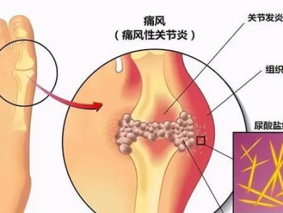 狗痛风的恢复需要多久？（探索狗痛风康复过程中的关键因素）
