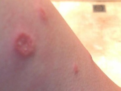了解黑斑癣的症状及治疗方法（探究黑斑癣的常见症状和有效治疗方案）