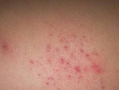 红色疹病（了解红色疹病及其症状）