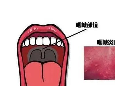 消化道型咽炎的症状及治疗方法（了解消化道型咽炎的症状，及时治疗保护喉咙健康）