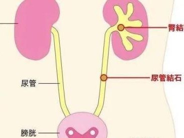 膀胱结石禁忌食物（了解膀胱结石的成因与风险，合理调整饮食习惯）